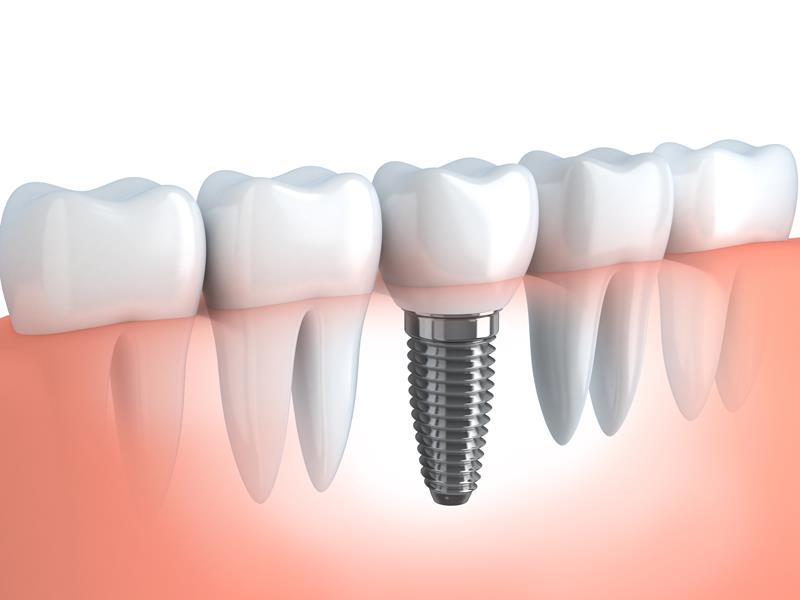 Dental Implants  Pickerington, OH