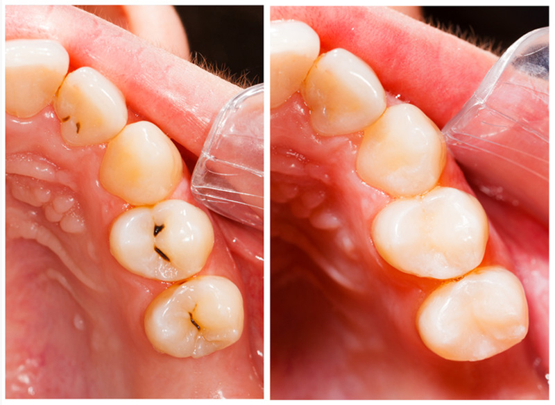 Fillings  Pickerington, OH