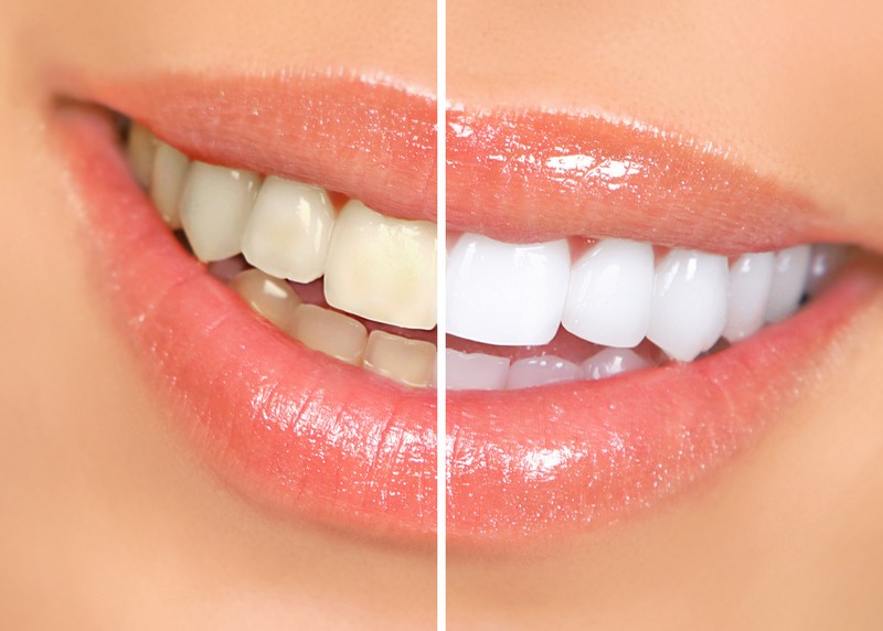 Teeth Whitening  Pickerington, OH
