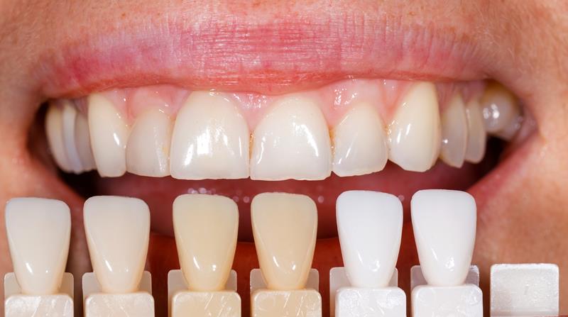 Veneers  Pickerington, OH